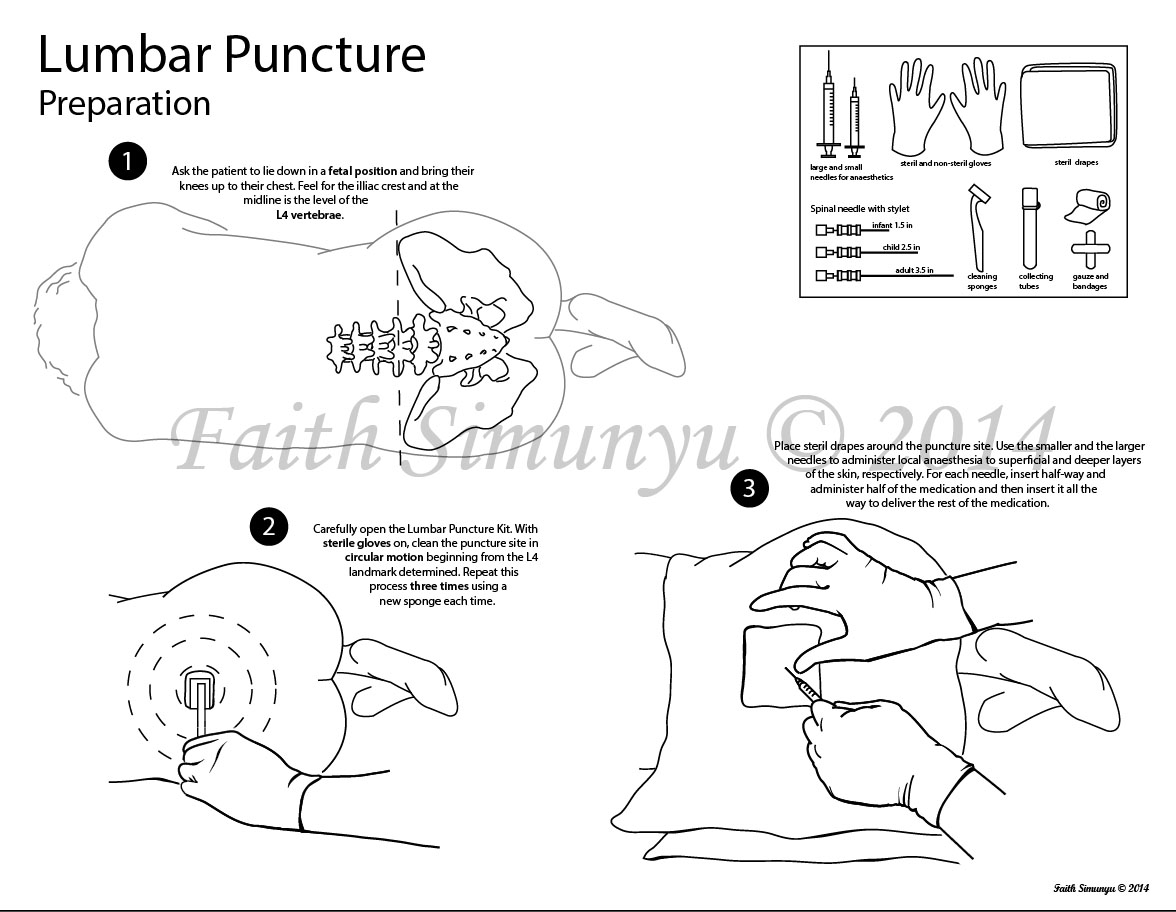 How to perform a Lumbar Puncture | A Collision Course